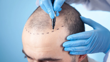 Hair Transplant Antalya | Haarex Clinic